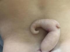 Hội chứng khiến em bé có đuôi dài 6cm