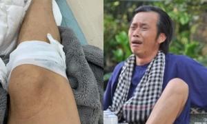 Danh hài Hoài Linh bị 'tai nạn' chảy máu chân, sa sẩm mặt mũi nhưng đối tượng 'gây án' lại cực bất ngờ