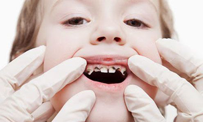 sâu răng ở trẻ, không nên thường xuyên hôn trẻ, lưu ý khi chăm sóc trẻ